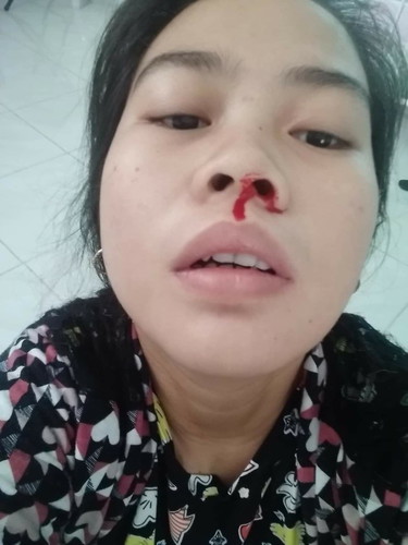 nose bleed