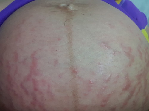 เป็นผื่นคันหนักมาก ใช้ยาหรือกินยาตัวไหนได้บ้างคะ