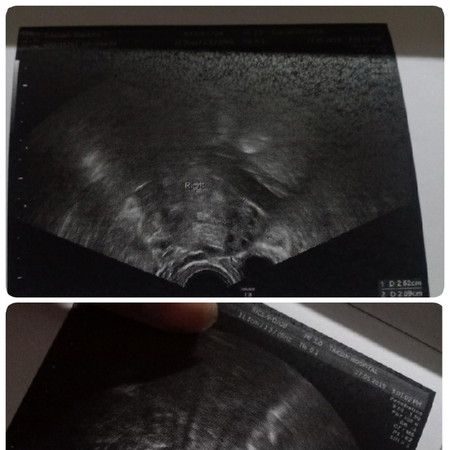 ใบซาวนี่คือถุงตั้งครรภ์ไหมคะ