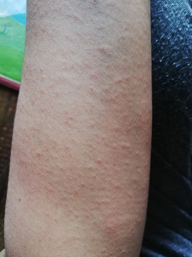 ผื่นขึ้นเต็มตัวแม่