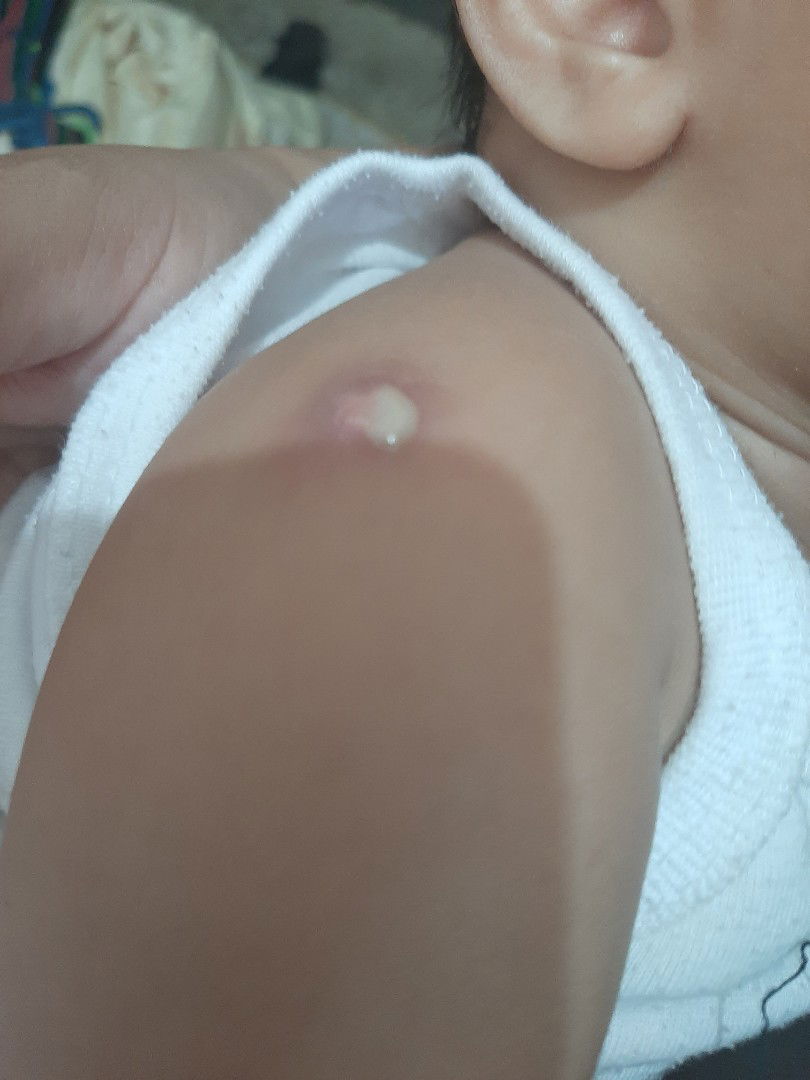 bcg vaccine effect on skin