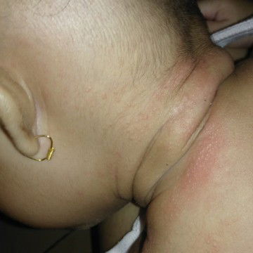 bayi 6bln ruam leher