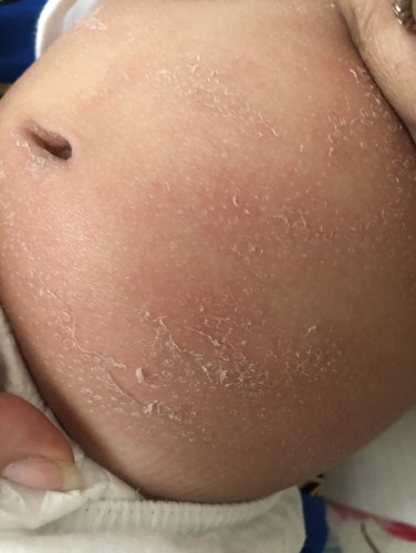 Baby skin peeling