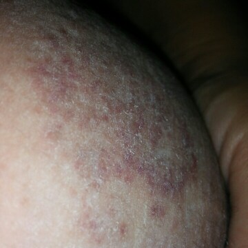 allergy
