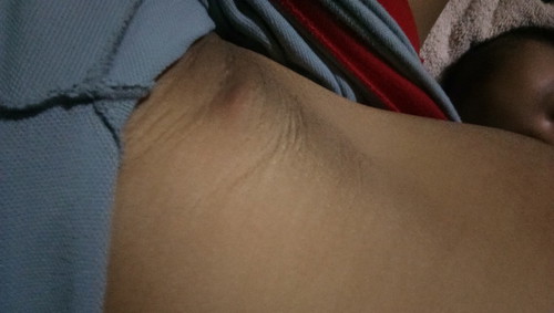parang bukol sa kilikili