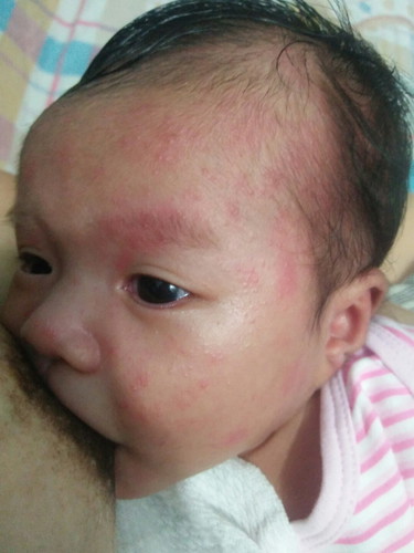 New born acne