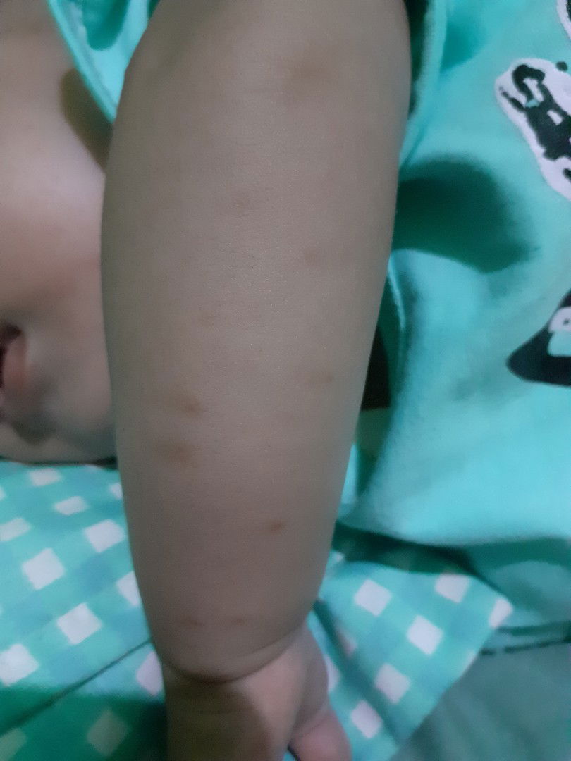 bekas gigitan nyamuk