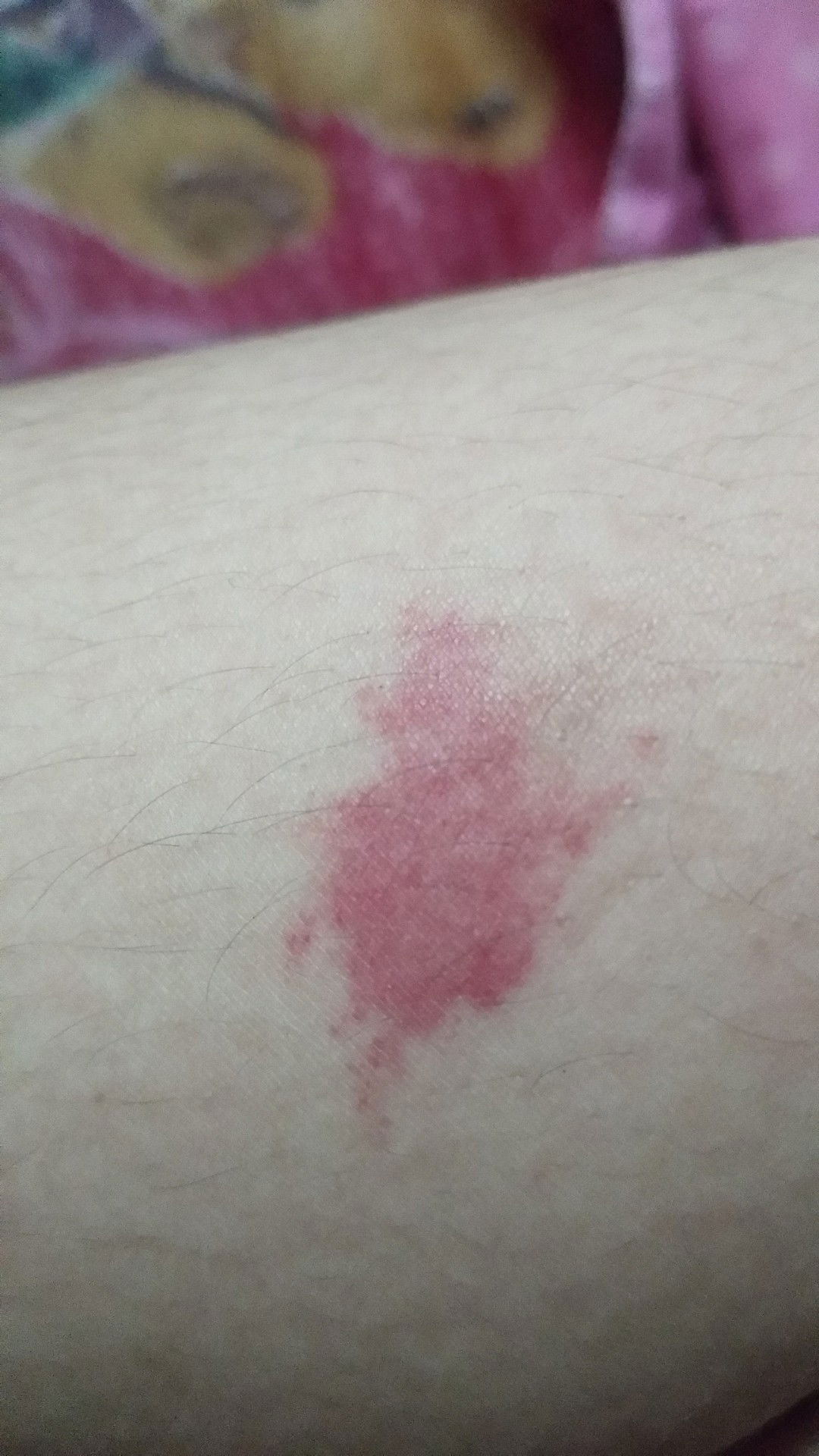 ตุ่มหมัด