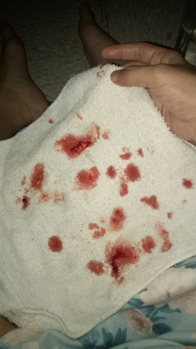 Nosebleed