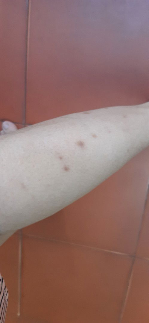 bầu bì mà toàn bị muỗi đốt thâm hết cả chân thì nên bôi thuốc hay kem gì được ạ? các mom hay dùng kem gì chống rạn và thâm chỉ giúp em với ạ