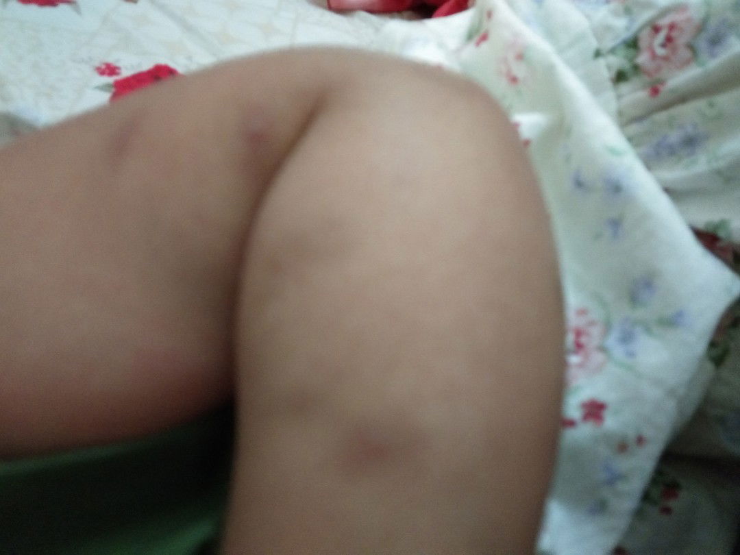 bekas hitam pada bayi