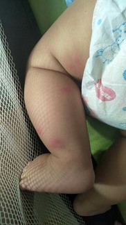 insect bites/surot ?