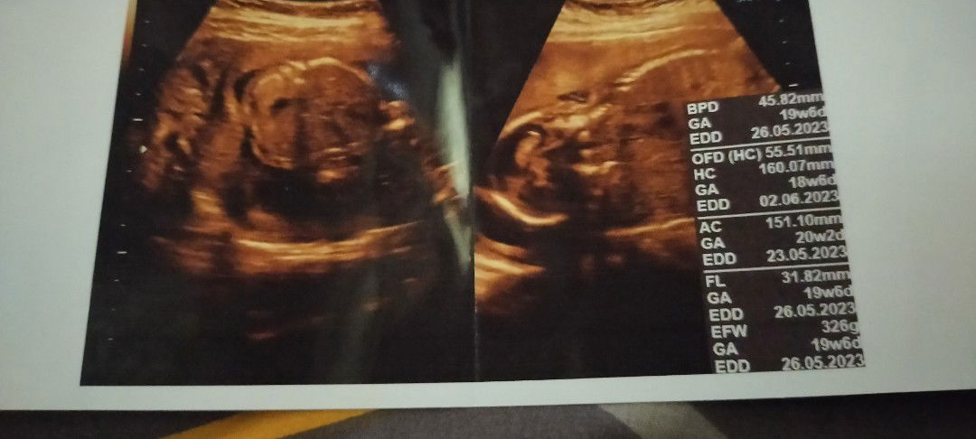 Kurangnya air ketuban