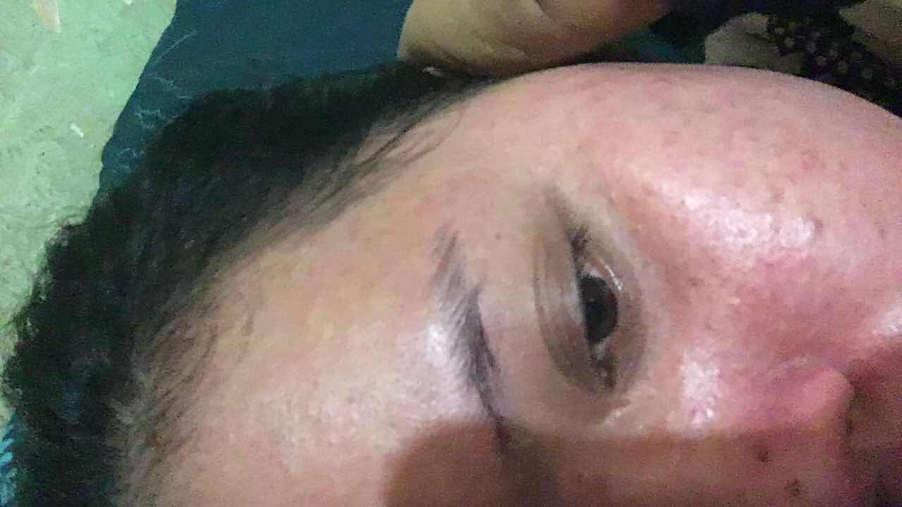 Kulit merah dan gatal seperti ruam