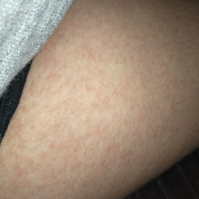 rashes