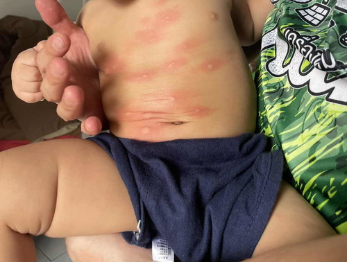 ลูกแพ้อาหาร ควรทำยังไง