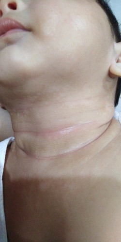 ano po kaya yung white patches sa leeg ng baby ko?