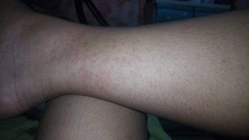 rashes