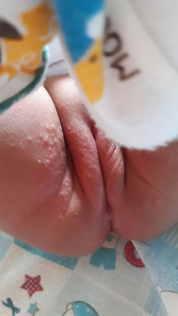 ruam pada disekitar alat kelamin anak