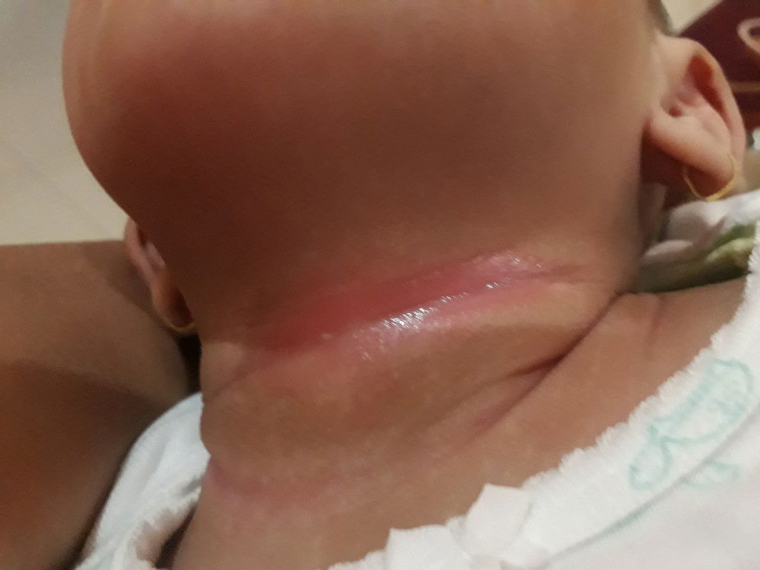 ruam kulit bayi pada lehee
