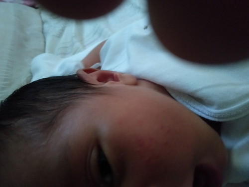 rashes sa mukha ni newborn