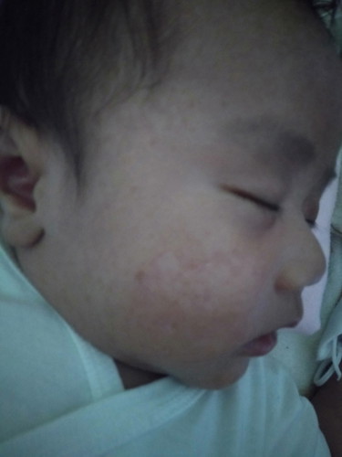 rashes