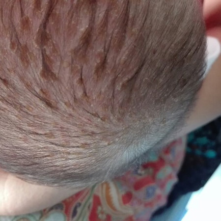 หัวเปนตุ่มเหมือนเปนแผล