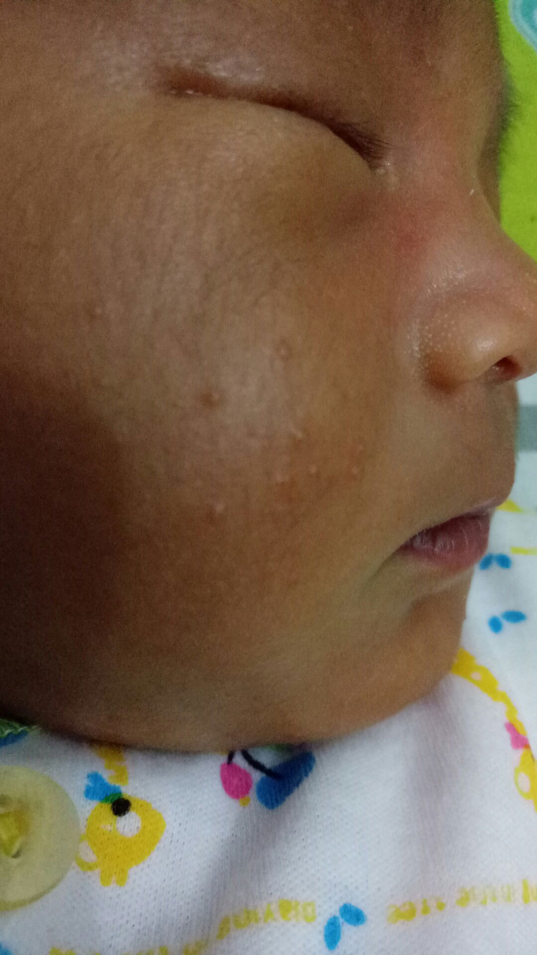 bayi NB titik2 d pipi