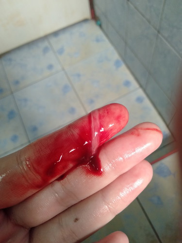 กระตุ้นปากมดลูก