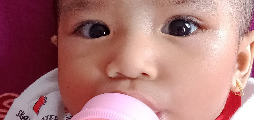 ada kayak benjolan2 putih di kelopak bawah mata bayi