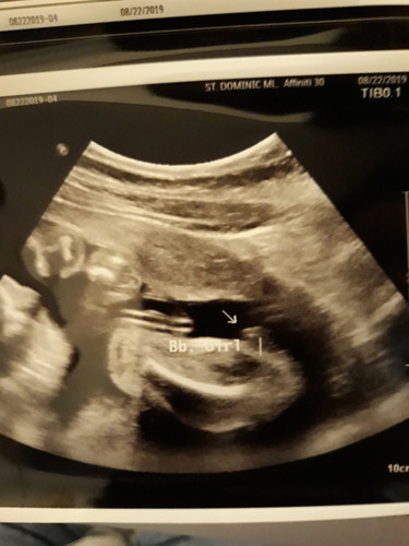 24weeks Ultrasound