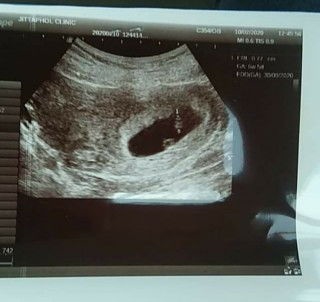 แม่ๆช่วยดูหน่อยค่ะ!!!  เราจะได้แฝดมั้ยคะ