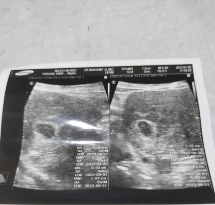 มีเลือดสีน้ำตาลออกติดทิชชู่และปวดท้องหน่วงๆ