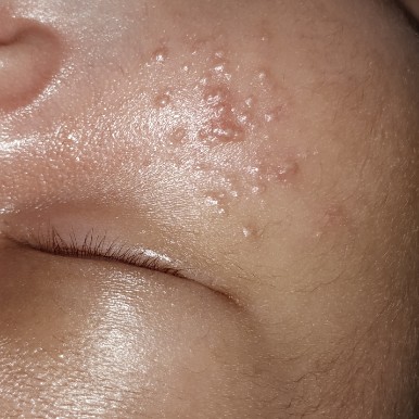 jerawat kecil pada bayi 3minggu