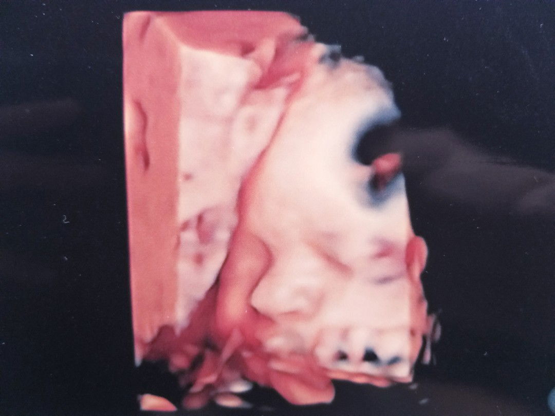 My amazing 4D ultrasound