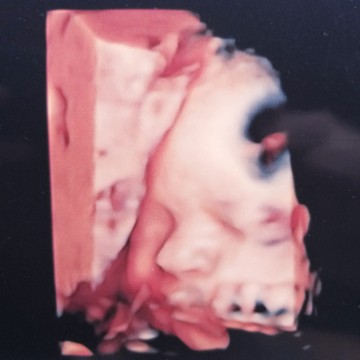 4D ultrasound