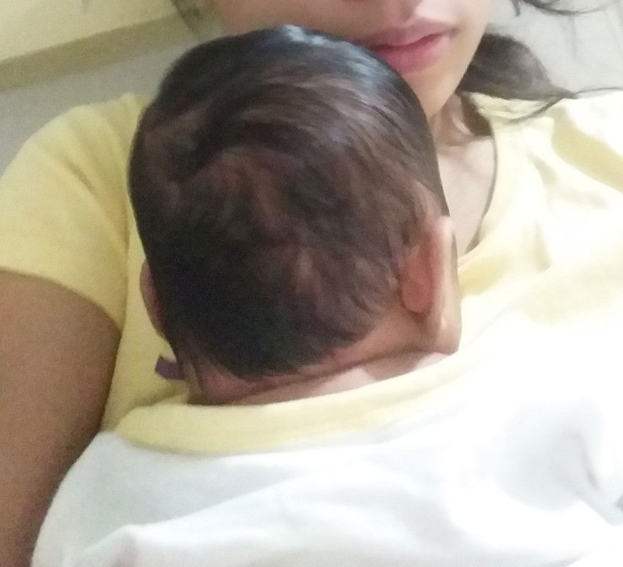 Flat Head / Plagiocephaly