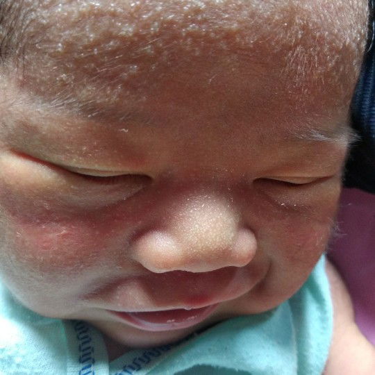 BINTIK BINTIK PADA WAJAH BAYI