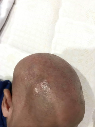 เพิ่งโกนผมไฟแล้วหัวเขาเป็นแดงๆไม่รุ้เขาจะแสบไหม