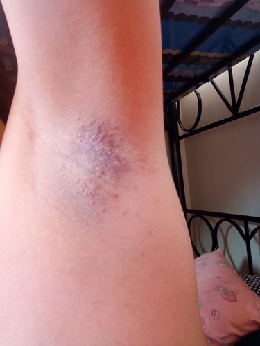 armpit rash