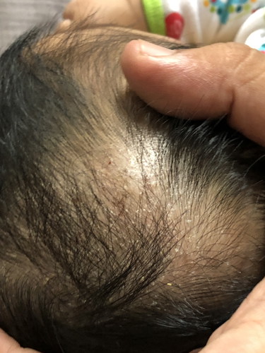 Kepala bayi terkelupas