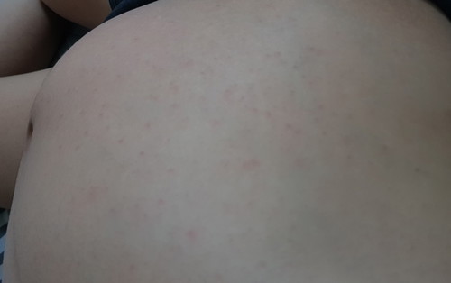 Red dots rash