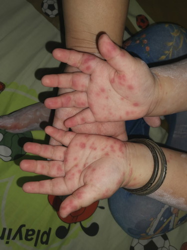 HFMD.