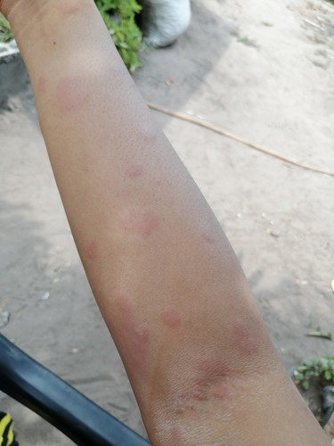 เป็นผื่น