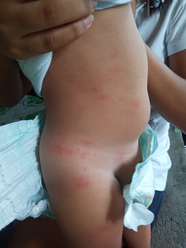 Rashes or allergies?