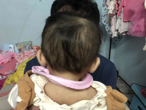 ลูกหัวแบนมาก