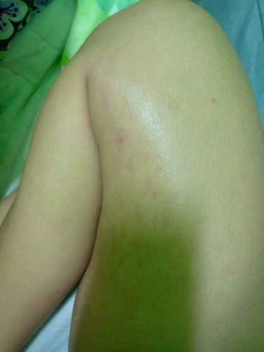 STRETCHMARKS SA MAY HITA.