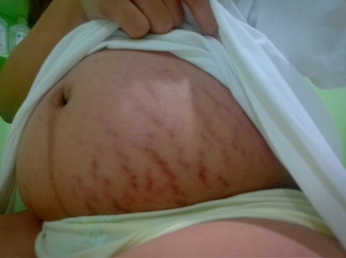 STRETCHMARKS
