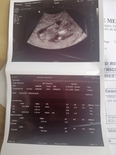 Small Gestational Sac Syndrome (SSGS)