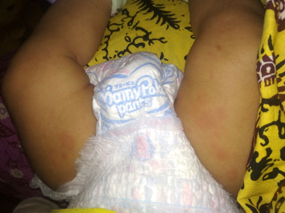 Bintik merah banyak di seluruh badan